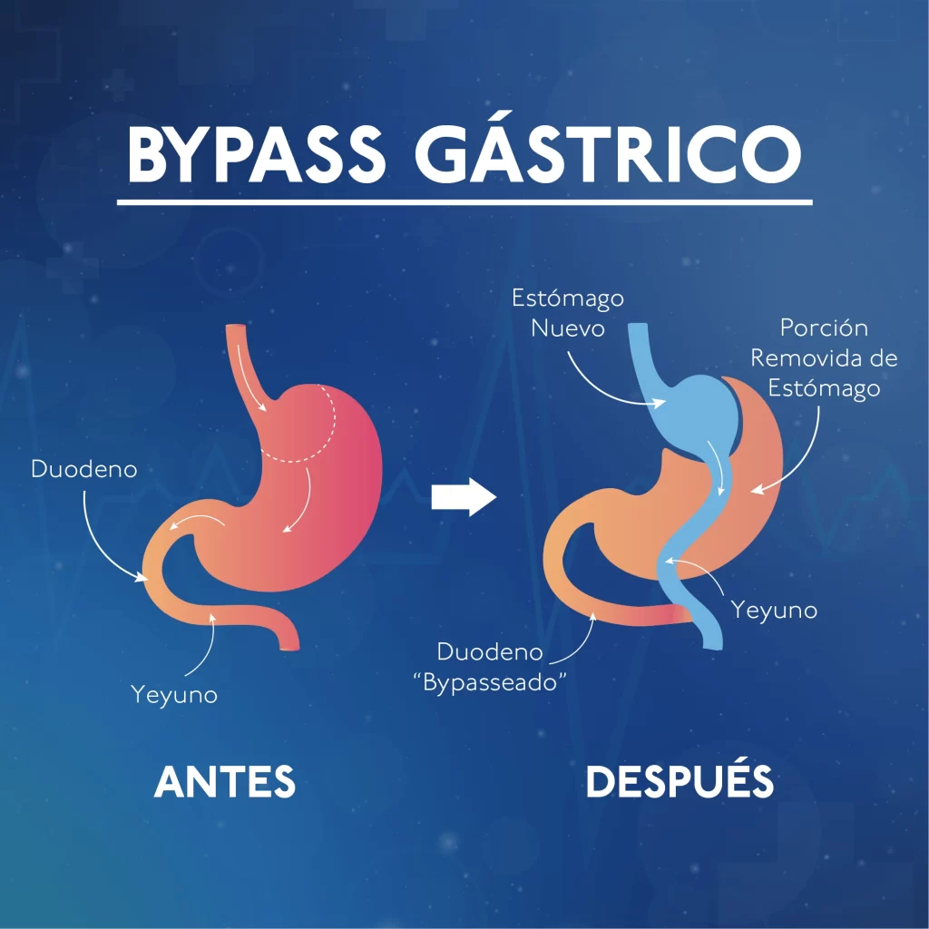 Bypass-Gastrico