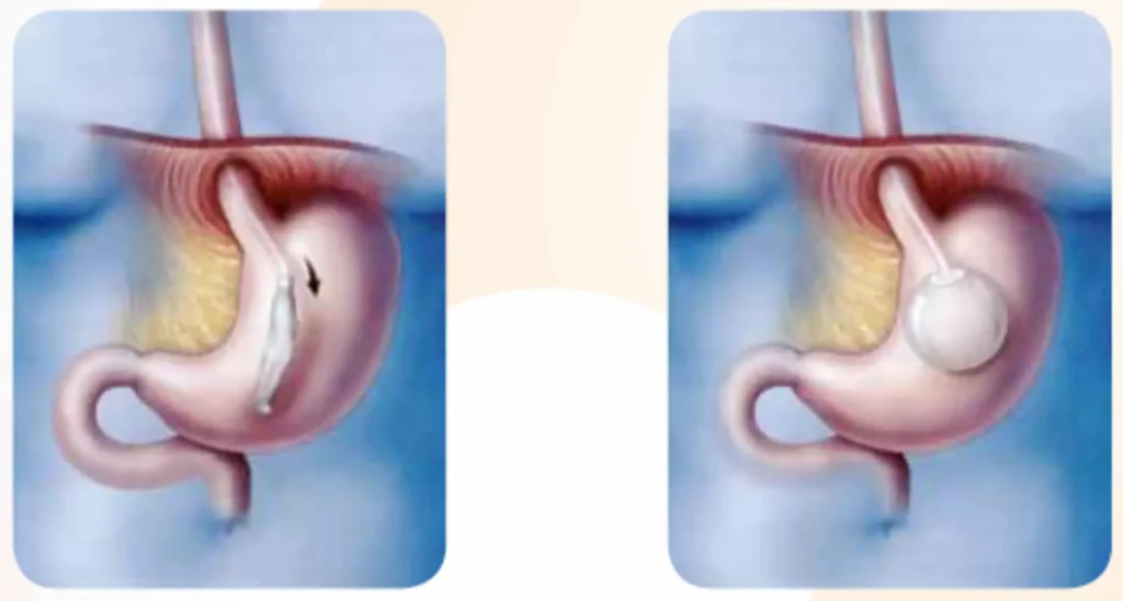 Proceso de inserción del balón intragástrico- Clinica de sobrepeso, obesidad y metabolismo