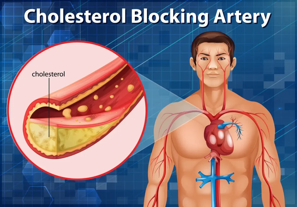 Imagen-del-corazon-con-arterias-afectadas-por-colesterol-alto-clinica-de-sobrepeso obesidad y metabolismo
